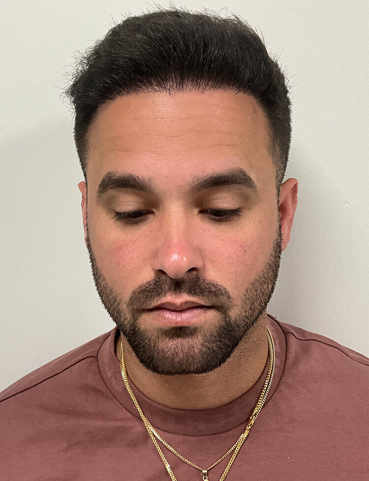 hair transplant before and after