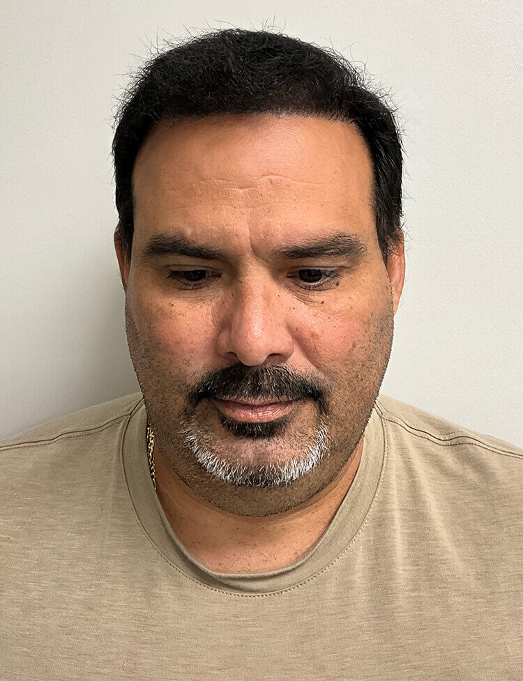 hair transplant before and after