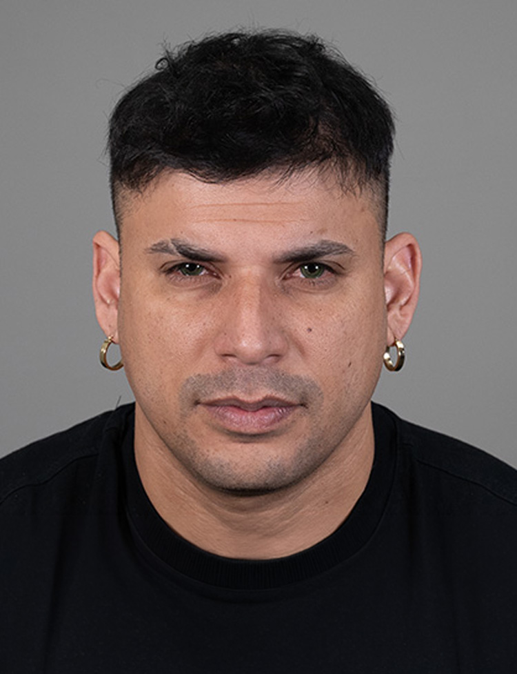 hair transplant after and after