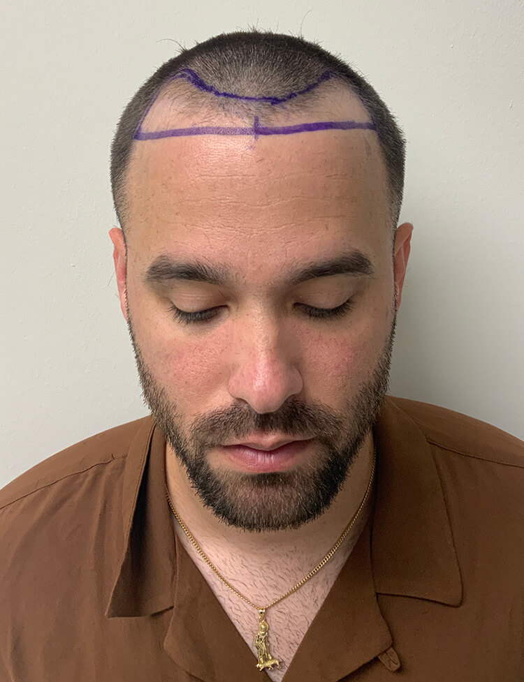 hair transplant before and after