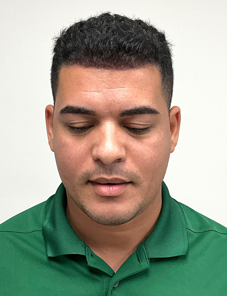 hair transplant before and after