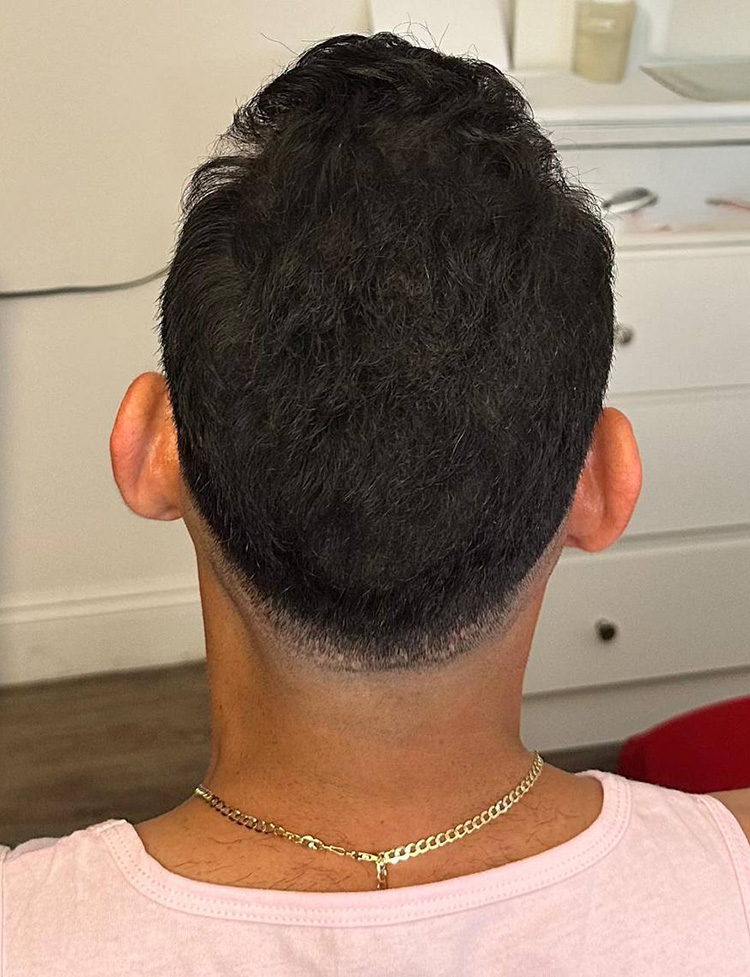 hair transplant before and after