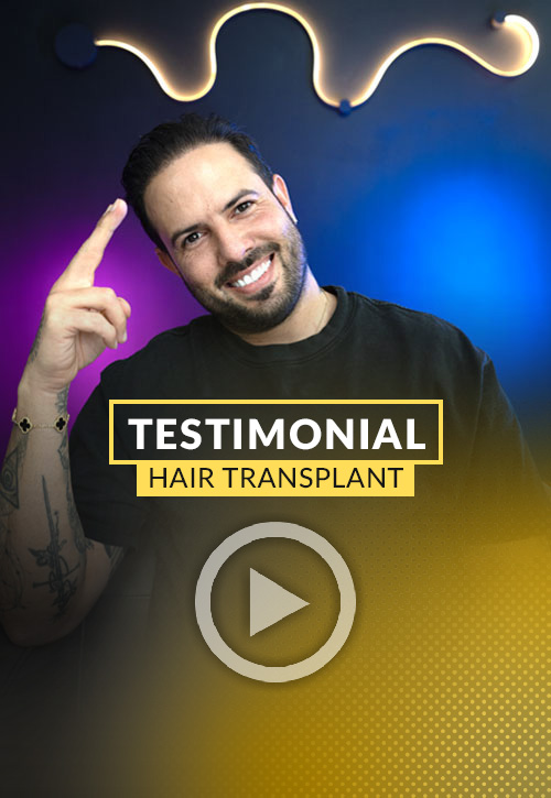 5000 grafts hair transplant video testimonial