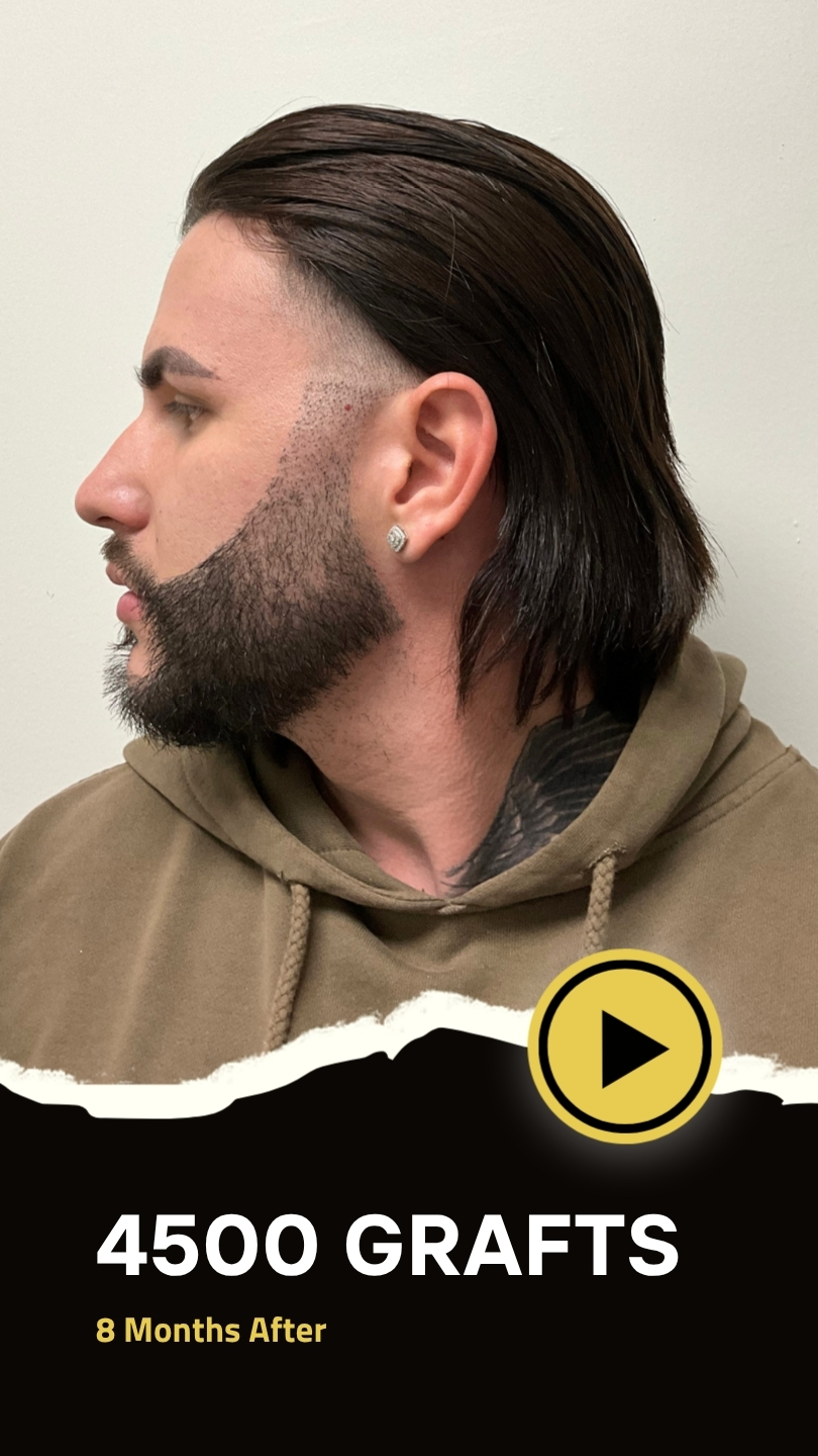 Beard Transplant Dayron is Only 4 months post